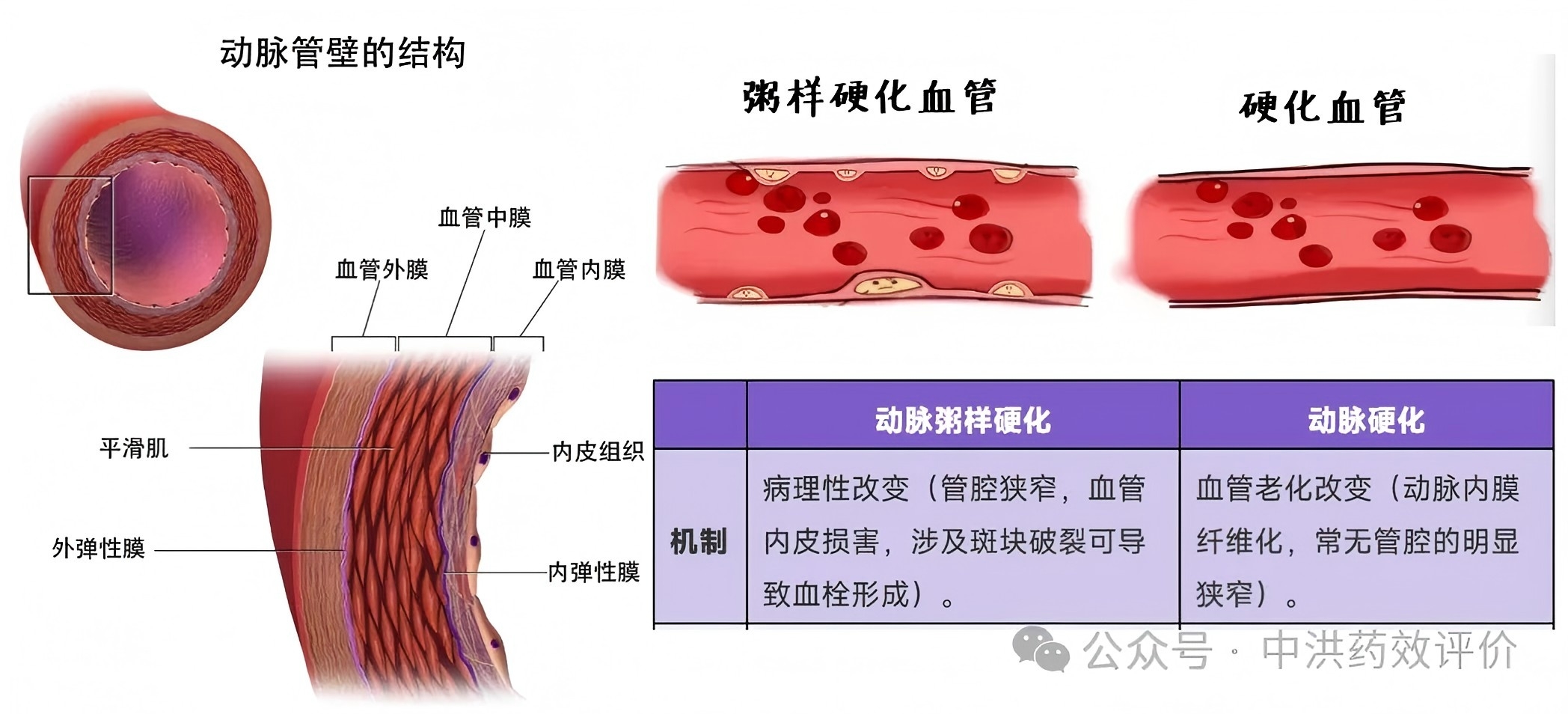 动脉粥样硬化研究2025年终盘点：从全新机制到新药上市，防线再升级