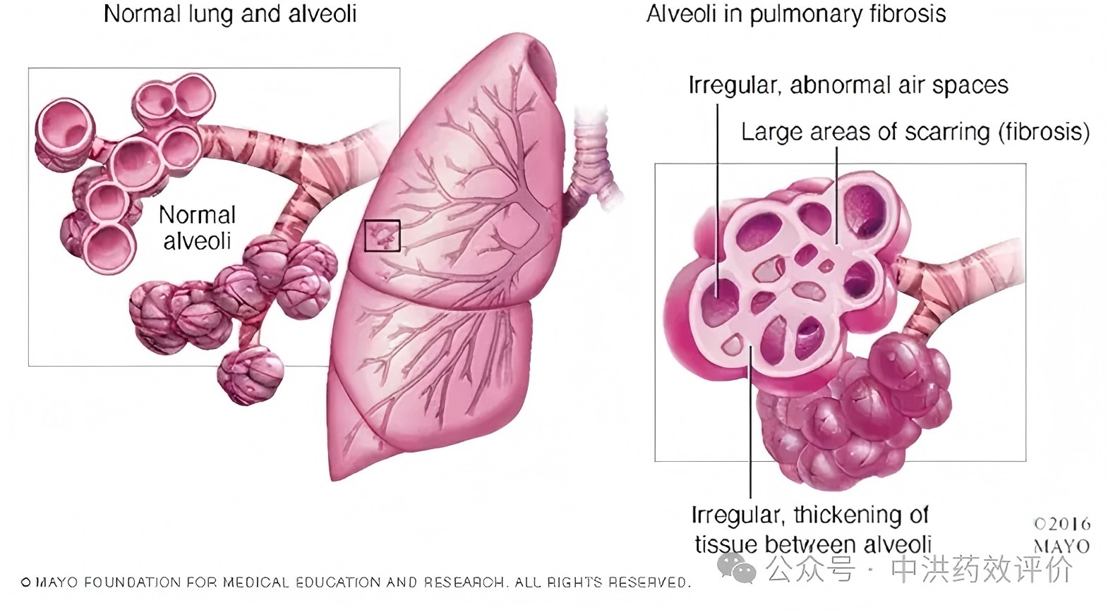十余年僵局打破：2025肺纤维化3大创新突破