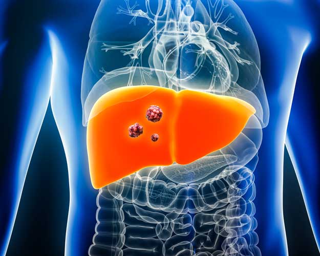 突破耐药困局！肝癌靶向与免疫治疗迎来多维革新