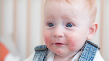 亿人受累！特应性皮炎创新药与靶点研究迎来爆发期