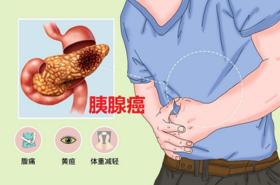 癌王有望终结：胰腺癌新靶点+新药联合治疗