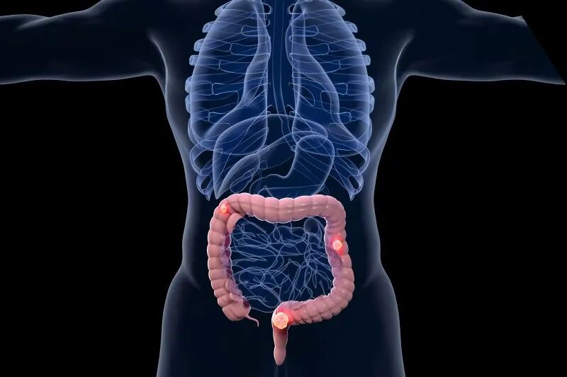 每年90万人死亡！从&ldquo;不可治愈&rdquo;到临床完全缓解，结直肠癌治疗迎来范式革命